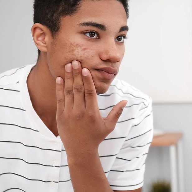 Roaccutane Sans Ordonnance