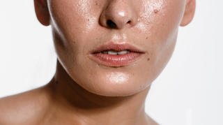 Roaccutane Sans Pilule